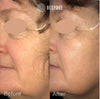 Before and after comparison of a woman's face with 'Bespoke' treatment.